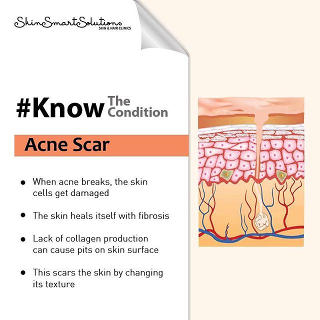 Acne Scar